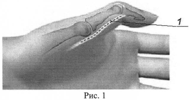 Способ устранения сгибательно-приводящей контрактуры первого пальца кисти у больных с детским церебральным параличом (патент 2537772)