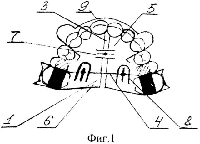Аппарат для лечения гнатической формы дистальной окклюзии у подростков (патент 2591637)