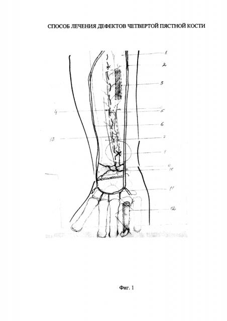 Способ лечения дефектов четвертой пястной кости (патент 2610534)