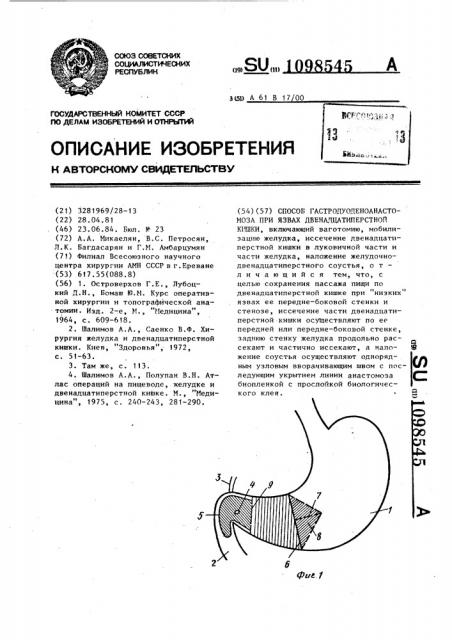 Способ гастродуоденоанастомоза при язвах двенадцатиперстной кишки (патент 1098545)