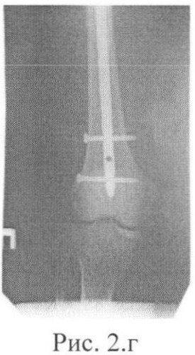 Способ хирургического лечения множественных переломов длинных костей нижних конечностей (патент 2414183)