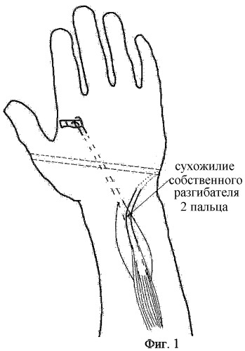 Способ восстановления активного противопоставления 1 пальца кисти (патент 2306888)
