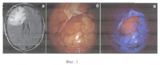 Способ проведения интраоперационной комбинированной спектроскопической диагностики опухолей головного и спинного мозга (патент 2497558)