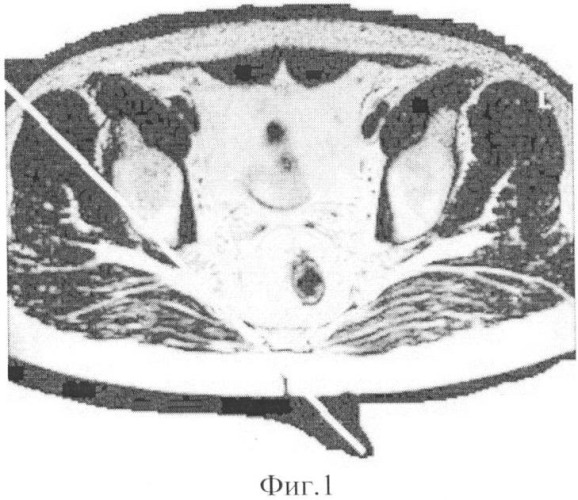 Способ диагностики повреждения крестцово-бугорных связок таза (патент 2352247)