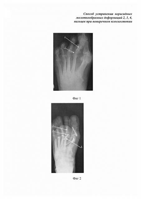 Способ устранения неригидных молоткообразных деформаций 2, 3, 4 пальцев при поперечном плоскостопии (патент 2610335)