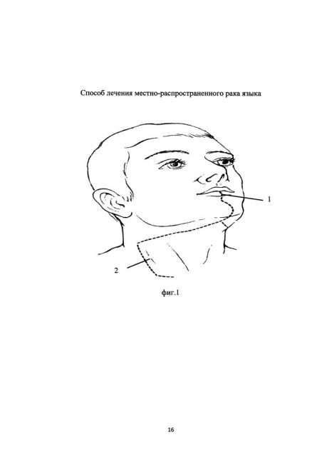 Способ лечения местно-распространенного рака корня языка (патент 2661011)