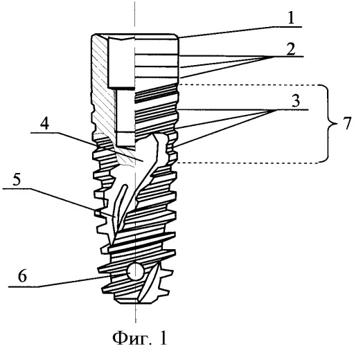 Дентальный внутрикостный имплантат (патент 2376955)