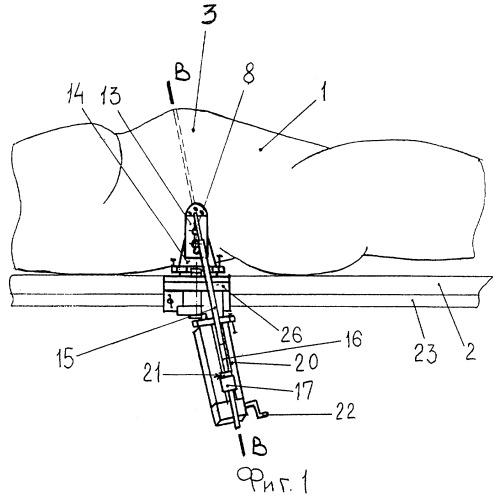 Способ подготовки пациента к лапароскопическому вмешательству и устройство для его осуществления (патент 2283037)