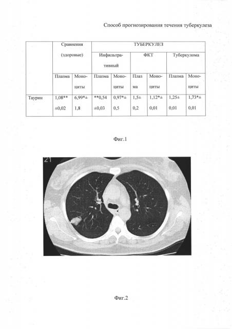 Способ прогнозирования течения туберкулеза (патент 2613320)