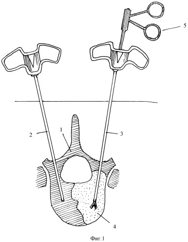 Способ малоинвазивного хирургического лечения опухолей позвонков (патент 2353315)