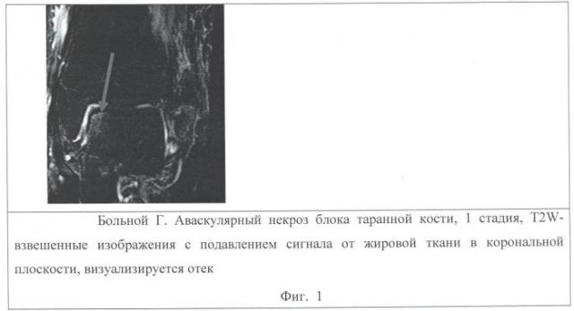 Способ выявления и оценки аваскулярного некроза блока таранной кости с использованием магнитно-резонансной томографии (патент 2403867)