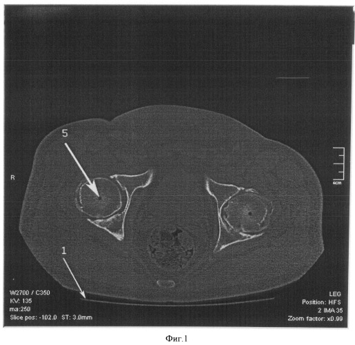 Способ оценки положения проксимального отдела бедренной кости (патент 2493774)