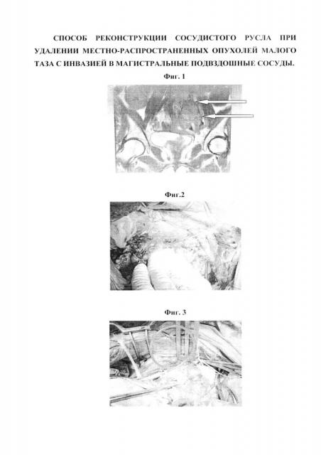 Способ реконструкции сосудистого русла при удалении местно-распространенных опухолей малого таза с инвазией в магистральные подвздошные сосуды (патент 2664629)