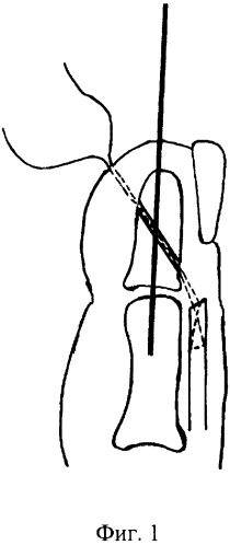 Способ лечения повреждения сухожилия разгибателя пальца кисти в области прикрепления к ногтевой фаланге (патент 2245682)