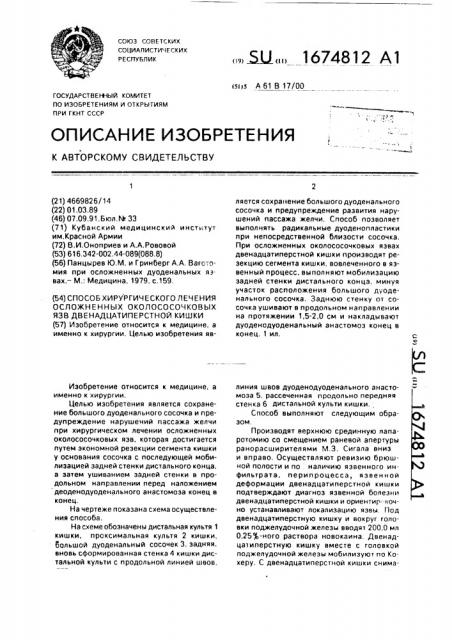 Способ хирургического лечения осложенных околососочковых язв двенадцатиперстной кишки (патент 1674812)