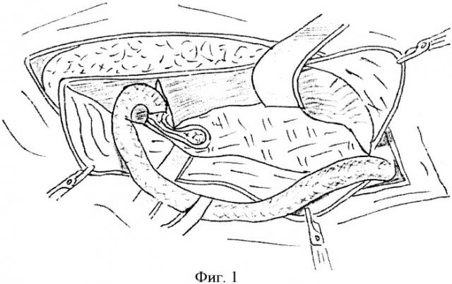 Способ хирургического лечения рецидивных паховых грыж (патент 2376940)