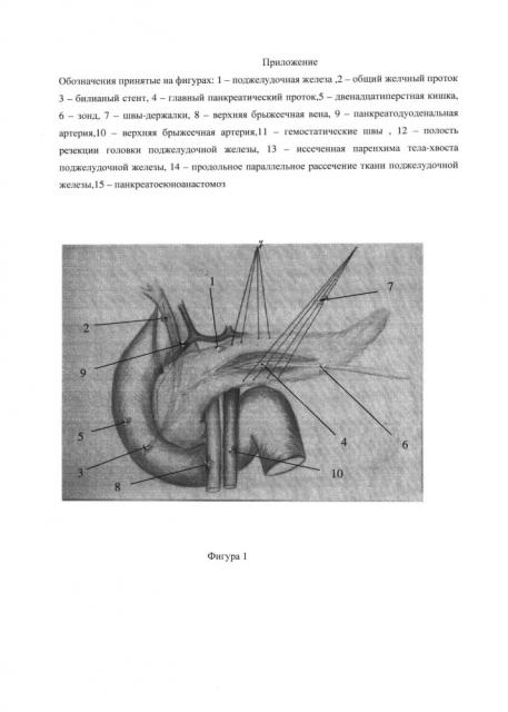 Резекционно-дренирующий способ хирургического лечения хронического кальцифицирующего панкреатита при нерасширенном главном панкреатическом протоке (патент 2646129)