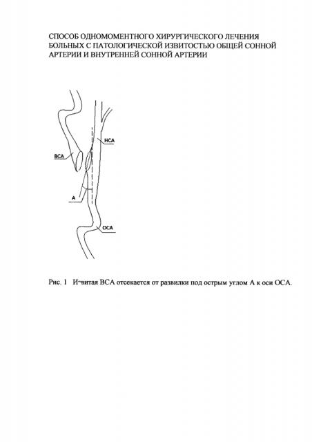 Способ одномоментного хирургического лечения больных с патологической извитостью общей сонной артерии и внутренней сонной артерии (патент 2618209)