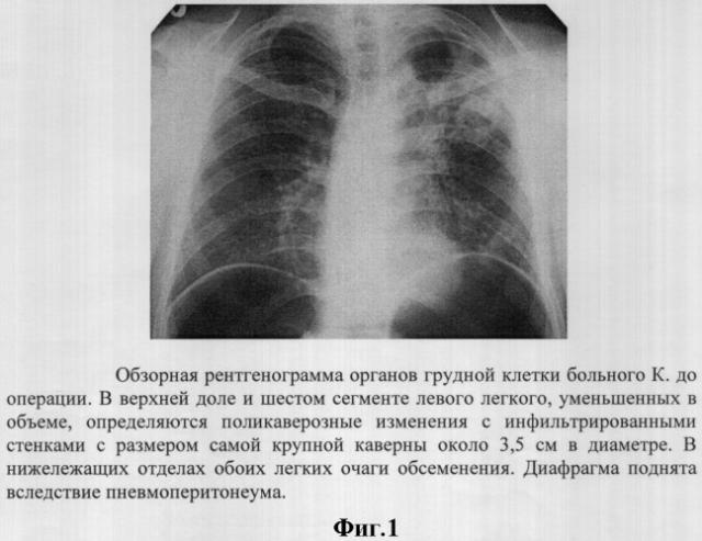 Способ лечения деструктивного туберкулеза легких (патент 2312616)