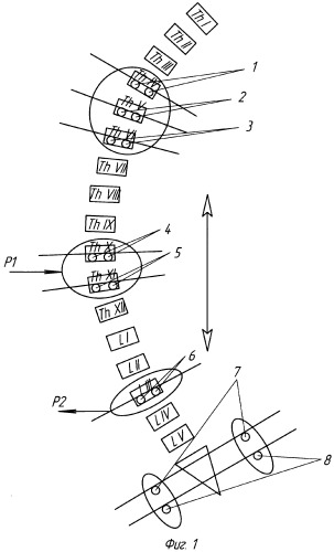 Способ коррекции с-образной деформации позвоночника (патент 2341218)