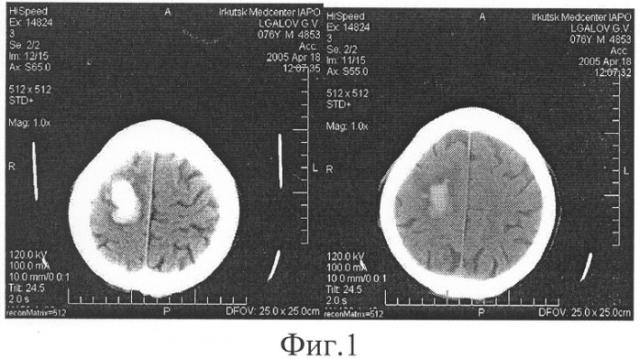 Способ лечения внутримозговых кровоизлияний (патент 2314838)