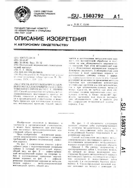 Способ изготовления несъемного металлокерамического мостовидного протеза по е.г.шияну (патент 1503792)