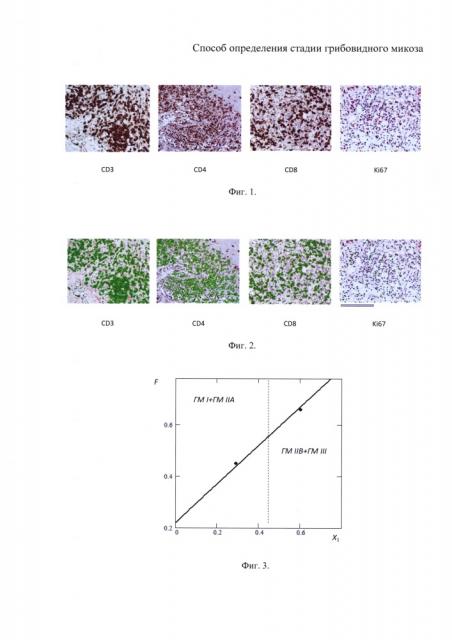 Способ определения стадии грибовидного микоза (патент 2660542)