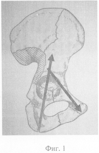 Способ закрытого остеосинтеза переломов вертлужной впадины (патент 2327427)
