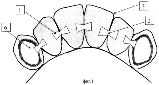 Способ изготовления временных несъемных зубных протезов (патент 2286745)