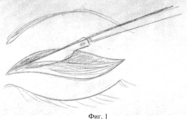 Способ хирургической коррекции а-образной деформации верхних век (патент 2578092)