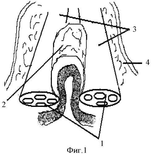 Способ герниопластики при гигантских вентральных грыжах (патент 2341206)