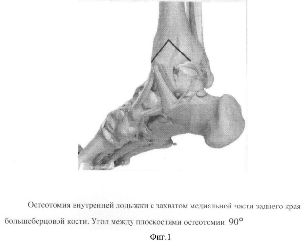 Способ оперативного доступа к таранной кости (патент 2431449)