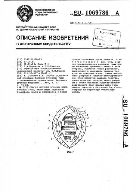 Способ лечения больших вентральных грыж (патент 1069786)