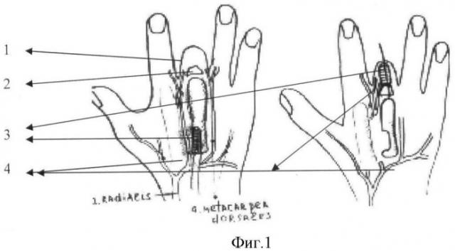 Способ подготовки к протезированию коротких культей (рудиментов) фаланг пальцев кисти (патент 2395244)