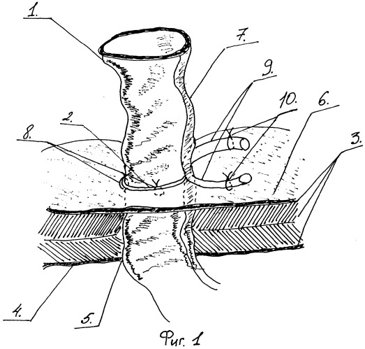 Способ формирования илеостомы (патент 2320278)