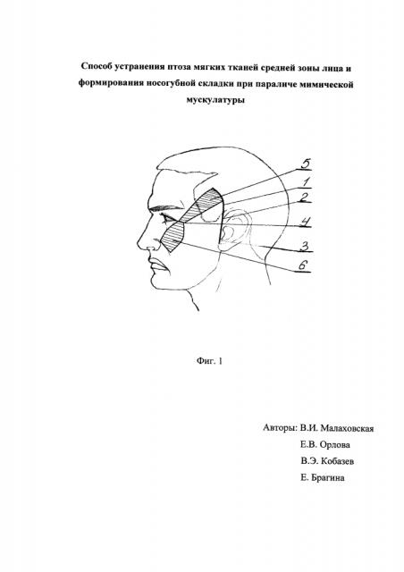 Способ устранения птоза мягких тканей средней зоны лица и формирования носогубной складки при параличе мимической мускулатуры (патент 2633344)