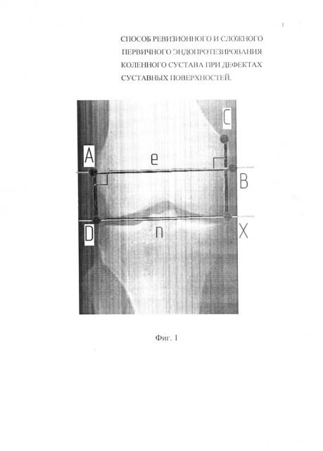 Способ ревизионного и сложного первичного эндопротезирования коленного сустава при дефектах суставных поверхностей (патент 2611911)