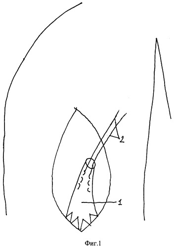 Способ хирургического лечения подкожных разрывов сухожилия длинной головки двуглавой мышцы плеча при недостаточной его длине (патент 2318462)