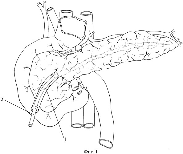 Способ хирургического лечения наружных панкреатических свищей (патент 2447839)