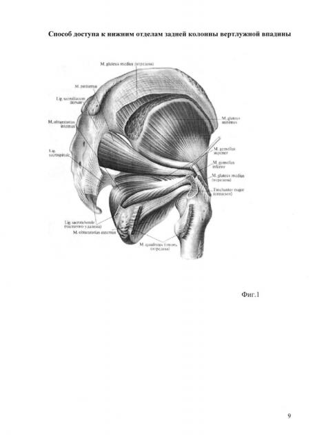 Способ доступа к нижним отделам задней колонны вертлужной впадины (патент 2624387)