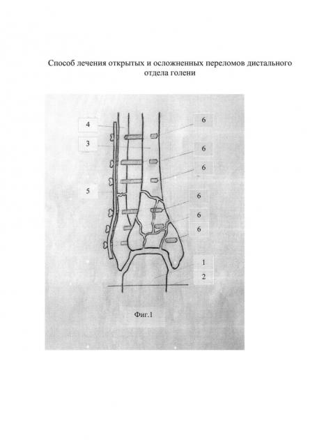 Способ лечения открытых и осложненных переломов дистального отдела голени (патент 2605647)