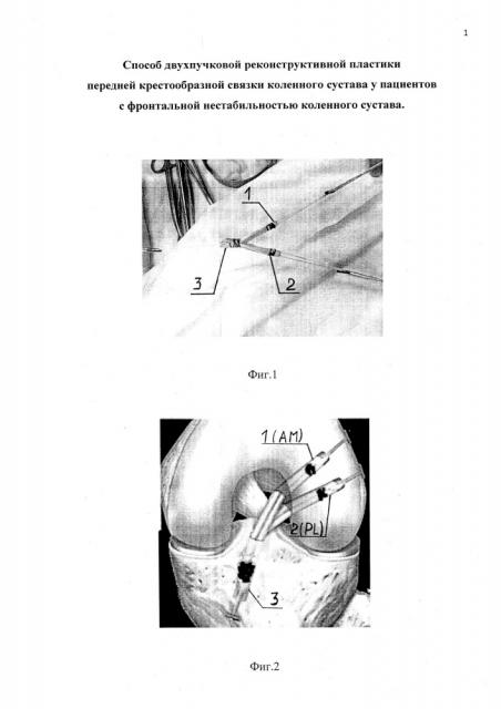 Способ двухпучковой реконструктивной пластики передней крестообразной связки коленного сустава у пациентов с фронтальной нестабильностью коленного сустава (патент 2621594)