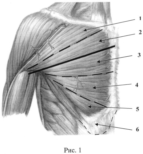 Способ восстановления двуглавой мышцы плеча у больных с артрогрипозом (патент 2492831)