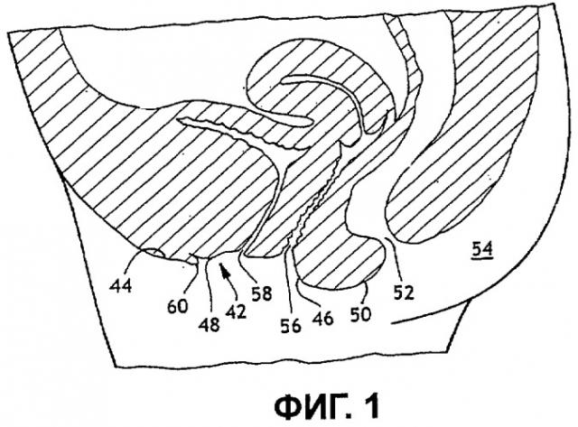 Интерлабиальная прокладка, содержащая язычок (варианты) (патент 2294186)