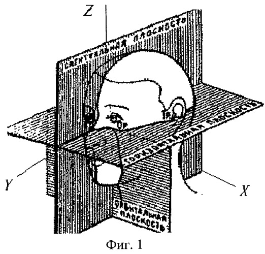 Способ прогнозирования ортодонтической коррекции ретенции верхних постоянных клыков (патент 2269968)