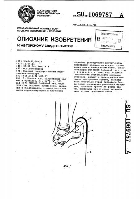 Способ закрытой репозиции перелома пяточной кости (патент 1069787)
