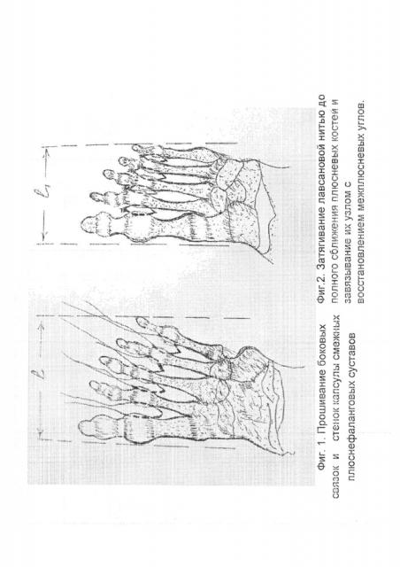 Способ лечения поперечной распластанности стопы (патент 2637603)