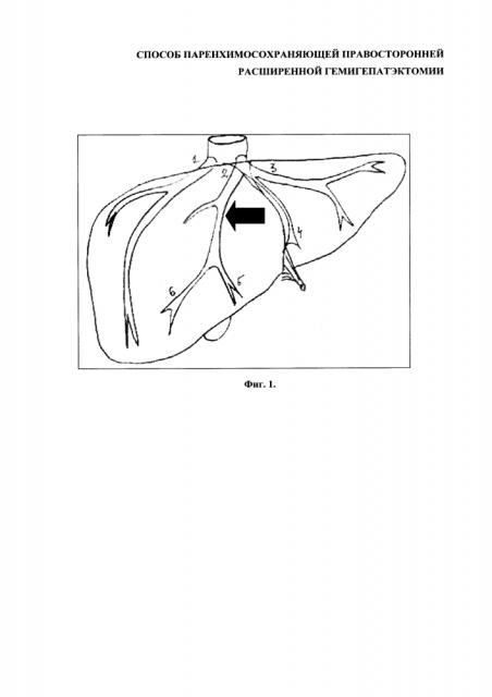 Способ паренхимосохраняющей правосторонней расширенной гемигепатэктомии (патент 2653637)