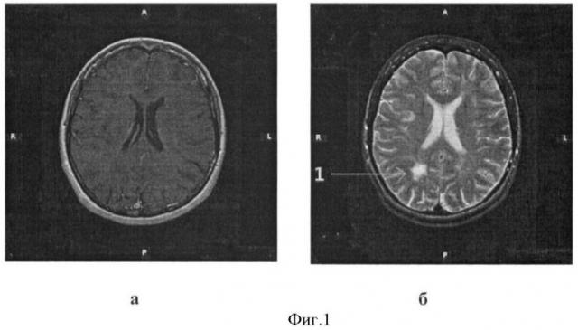 Способ определения тяжести дегенеративных изменений в головном мозге больных рассеянным склерозом (патент 2426495)