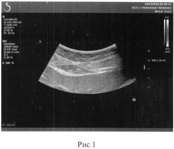 Ультразвуковой способ определения толщины жировой ткани в абдоминальной области (патент 2525664)